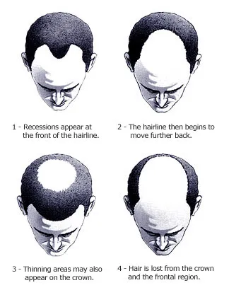 generisches finasteride